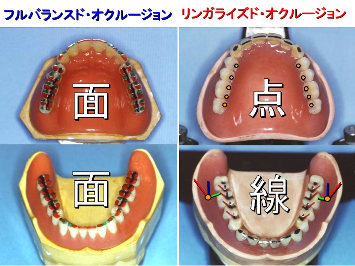 フルバランスド・オクルージョンリンガライズド・オクルージョン