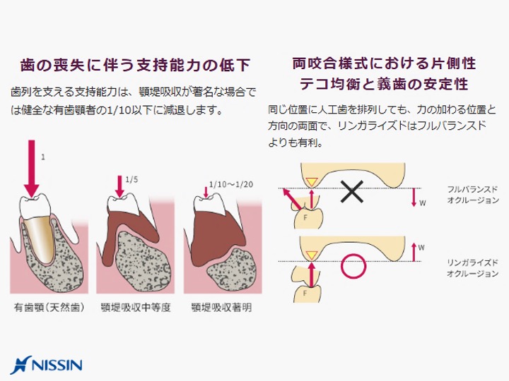 歯の喪失に伴う支持能力の低下