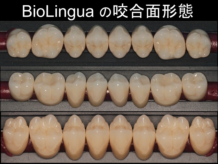 BioLinguaの咬合面形態