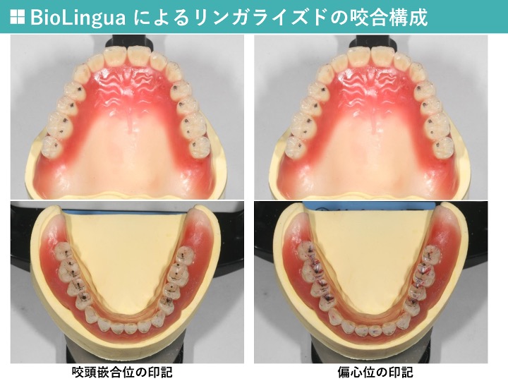 BioLinguaによるリンガライズドの咬合構成
