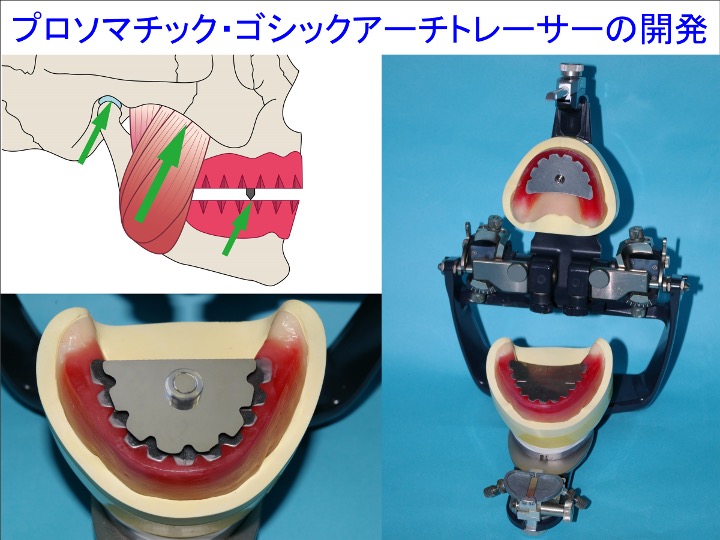 プロソマチック・ゴシックアーチトレーサーの開発