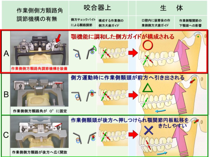 作業側側方顆路角調節機構の有無