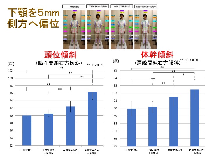 下顎を5mm側位へ偏位