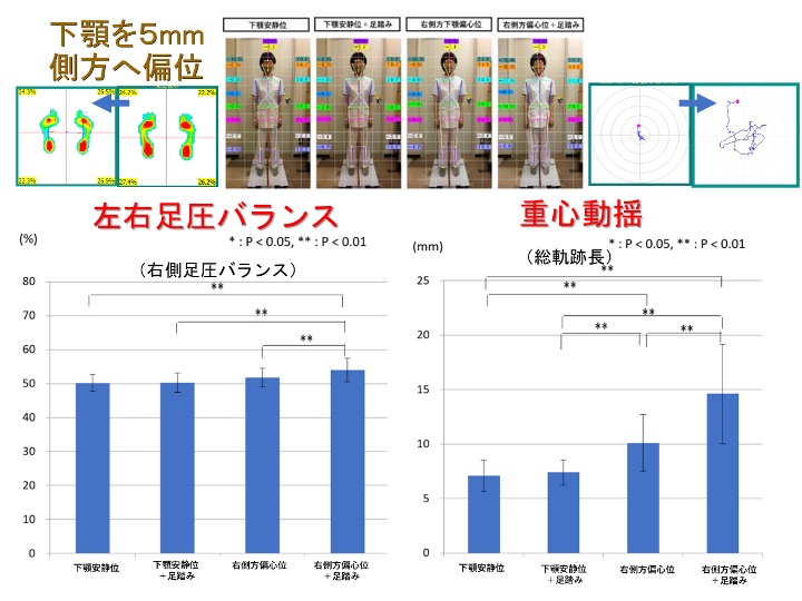 下顎を5mm側位へ偏位