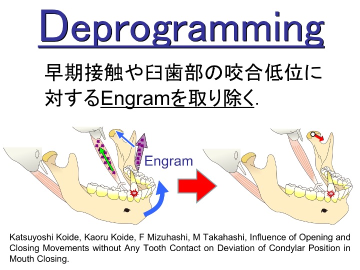 Deprogramming 早期接触や臼歯部の咬合低位に対するEngramを取り除く