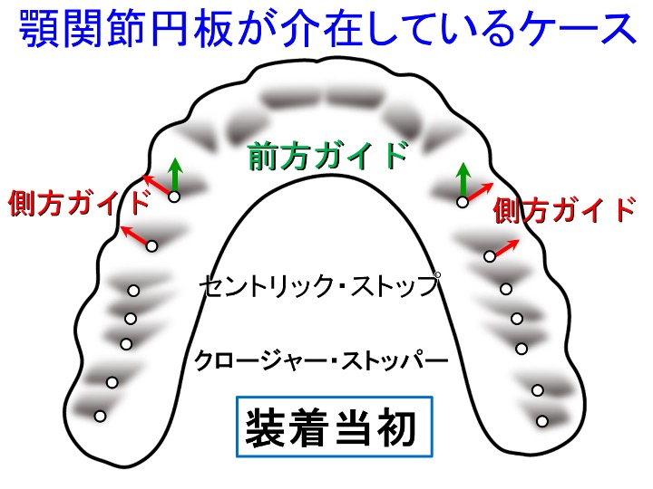 顎関節円板が介在しているケース