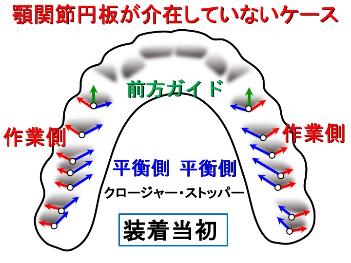 顎関節円板が介在していないケース