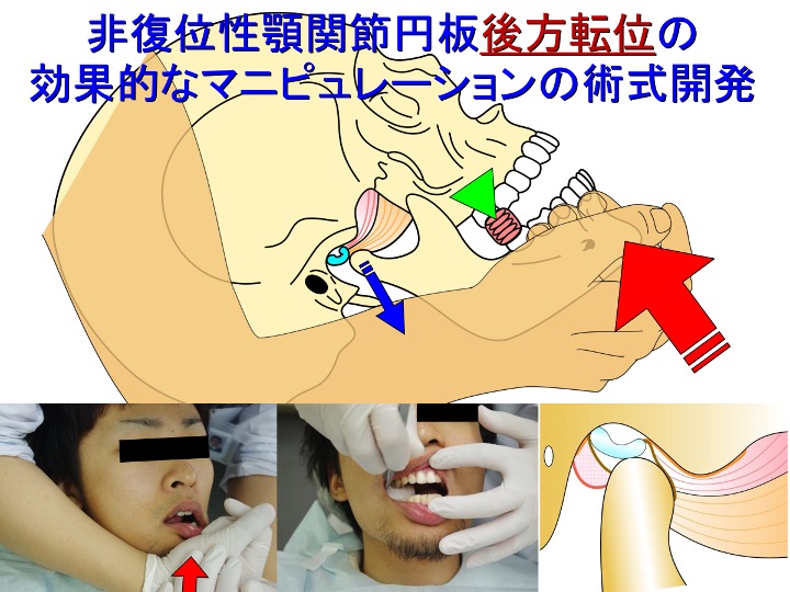 非復位性顎関節円板後方転位の効果的なマニピュレーションの術式開発