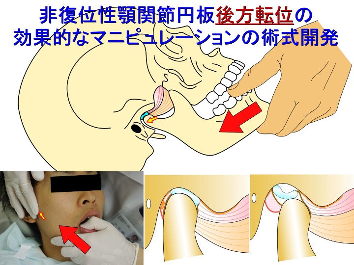 非復位性顎関節円板後方転位の効果的なマニピュレーションの術式開発