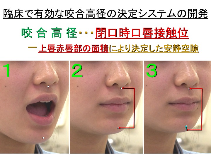 臨床で有効な咬合高径の決定システムの開発