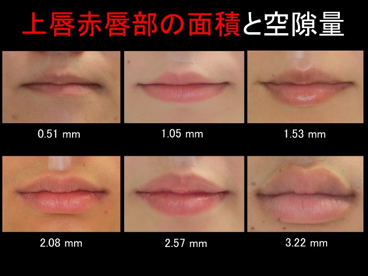 上唇赤唇部の面積と空隙量