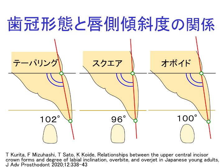 歯冠形態と唇側傾斜度の関係
