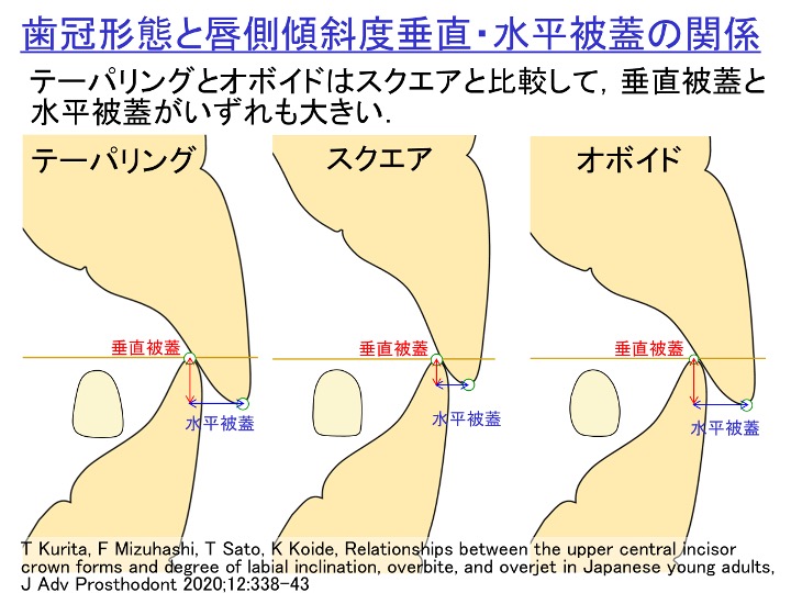 歯冠形態と唇側傾斜度垂直・水平被蓋の関係