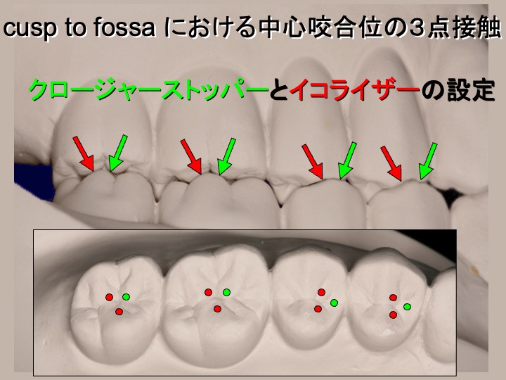 cusp to fossaにおける中心咬合位の3点接触
