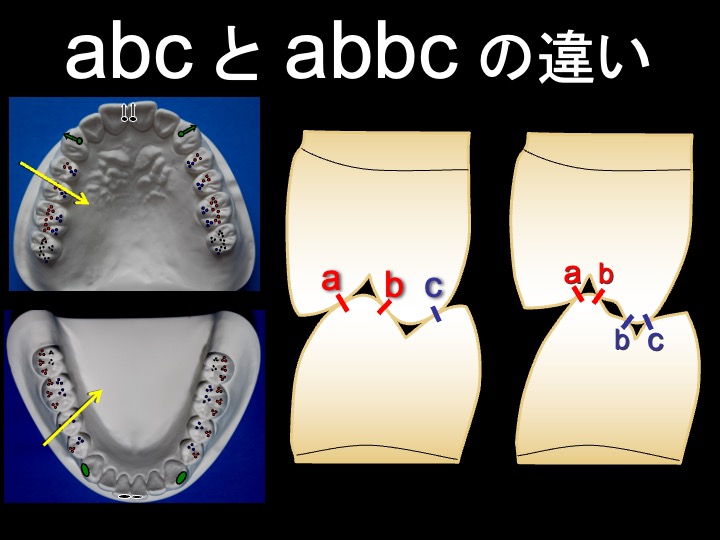 abcとabbcの違い