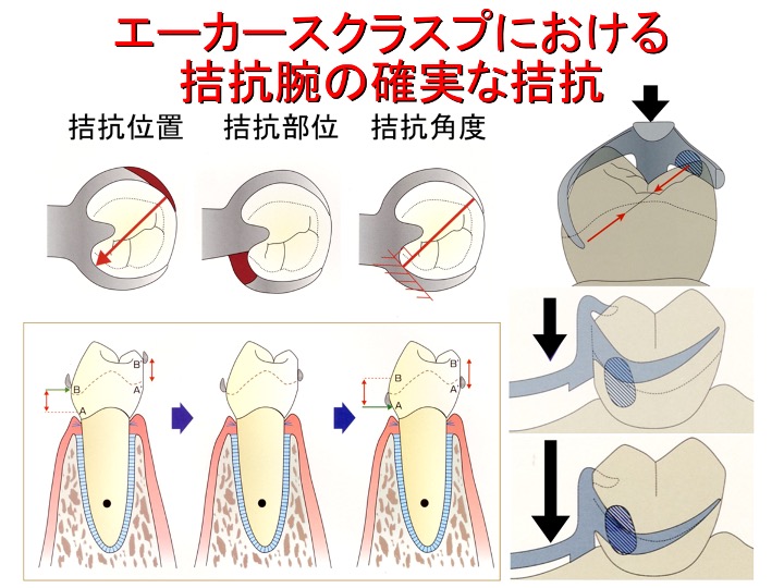 エーカースクラスプにおける拮抗腕の確実な拮抗