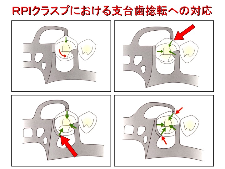 RPIクラスプにおける支台歯捻転への対応