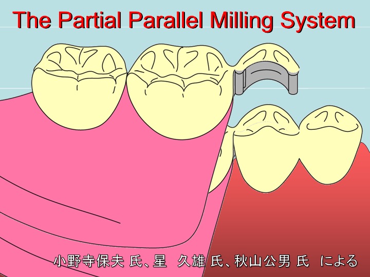 The Partial Parallel Milling System