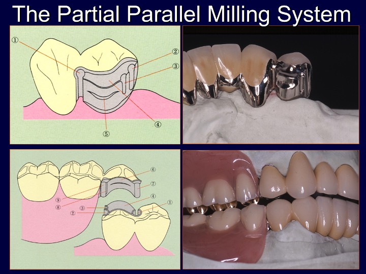 The Partial Parallel Milling System