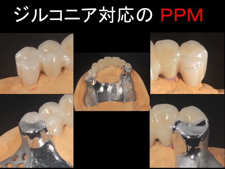 ジルコニア対応のPPM