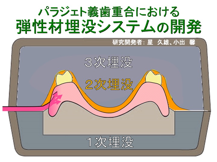 パラジェット義歯重合における弾性材埋没システムの開発